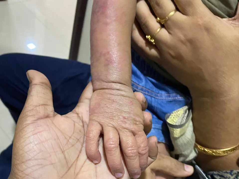 ectopic dermatitis a2