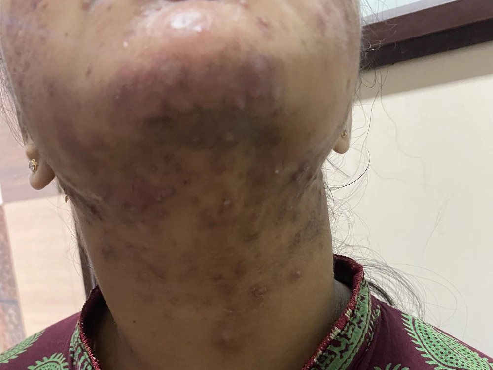 acne condition 1