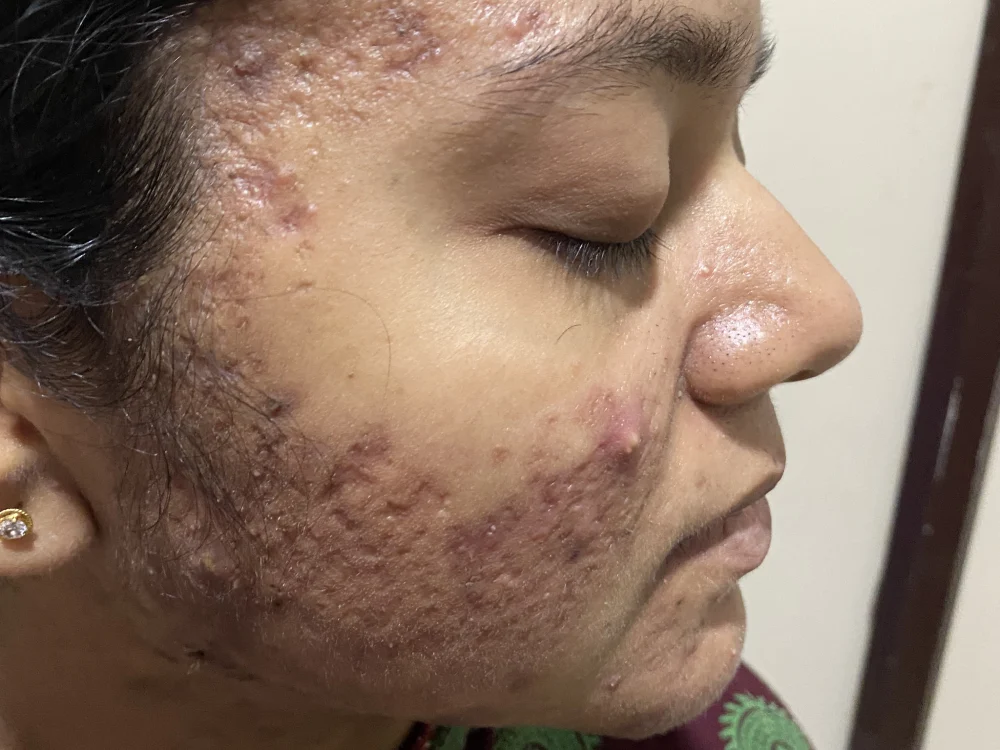 acne condition 2