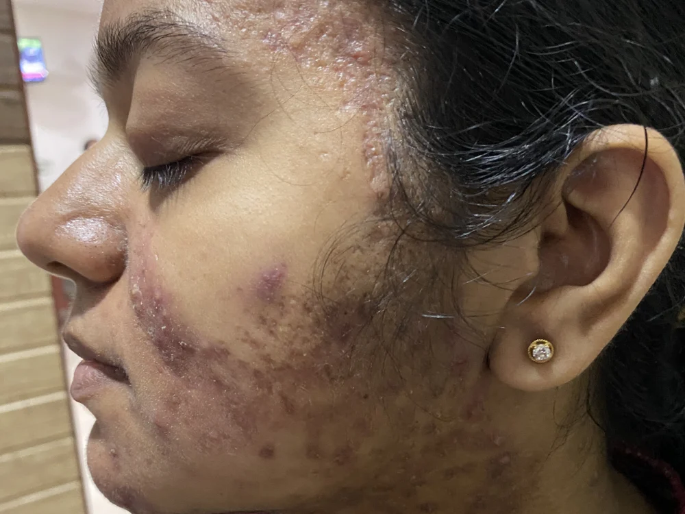 acne condition 3