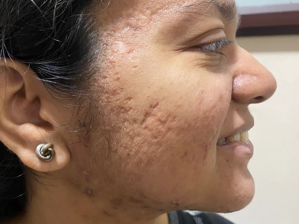 acne condition after 2