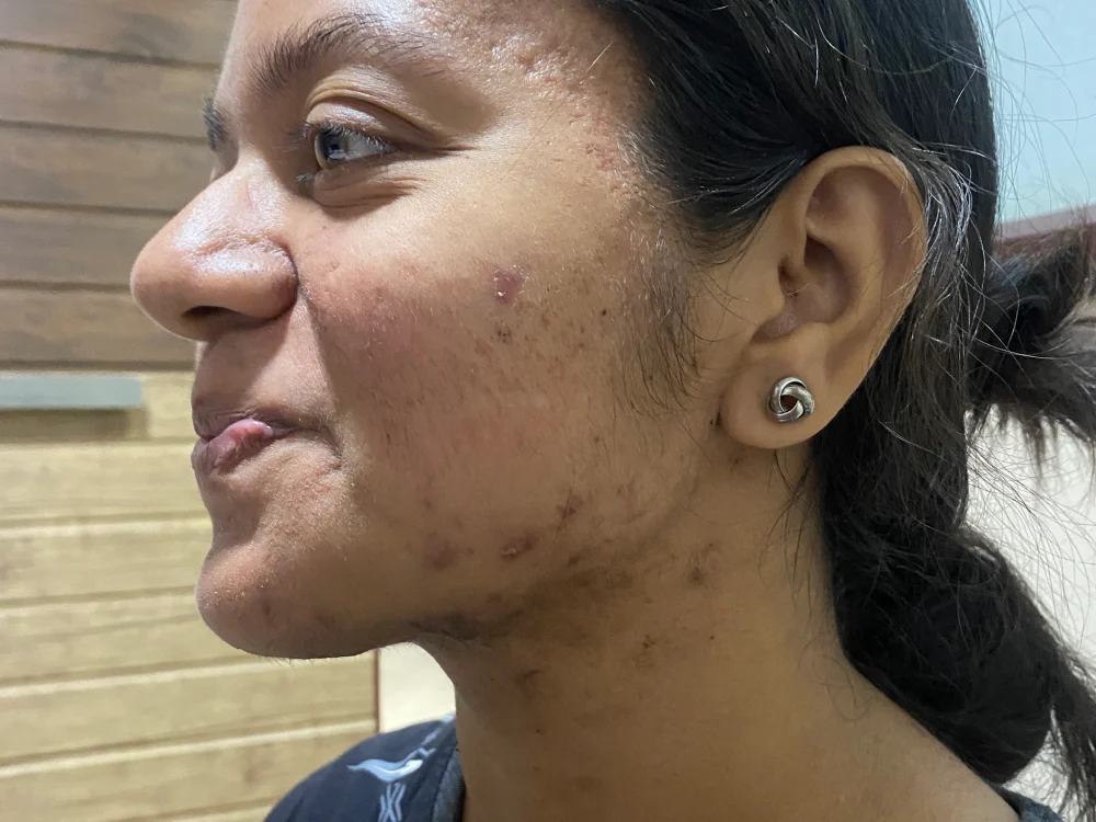 acne condition after