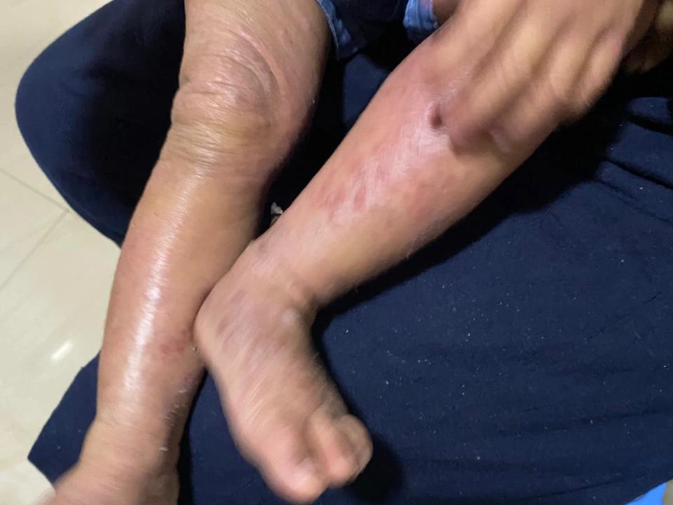 ectopic dermatitis a2
