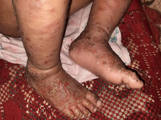 ectopic dermatitis 2