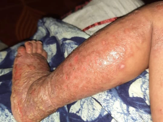 ectopic dermatitis 4