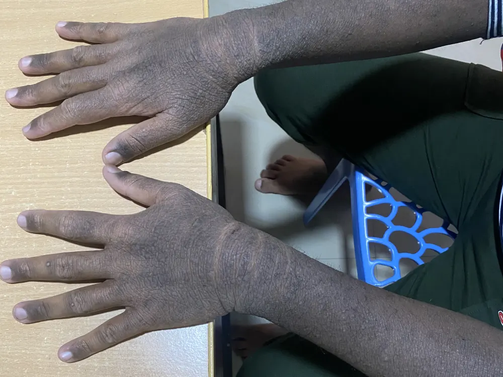 eczema 1