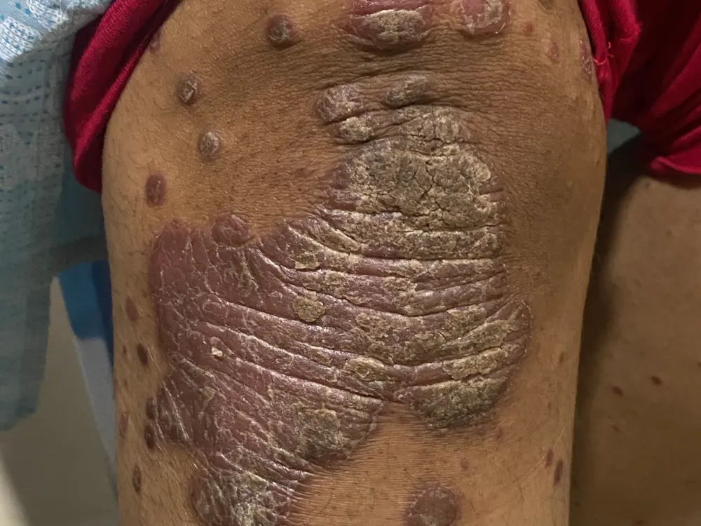 psorias 6