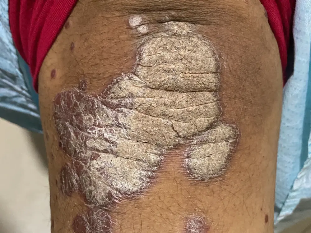 psorias3