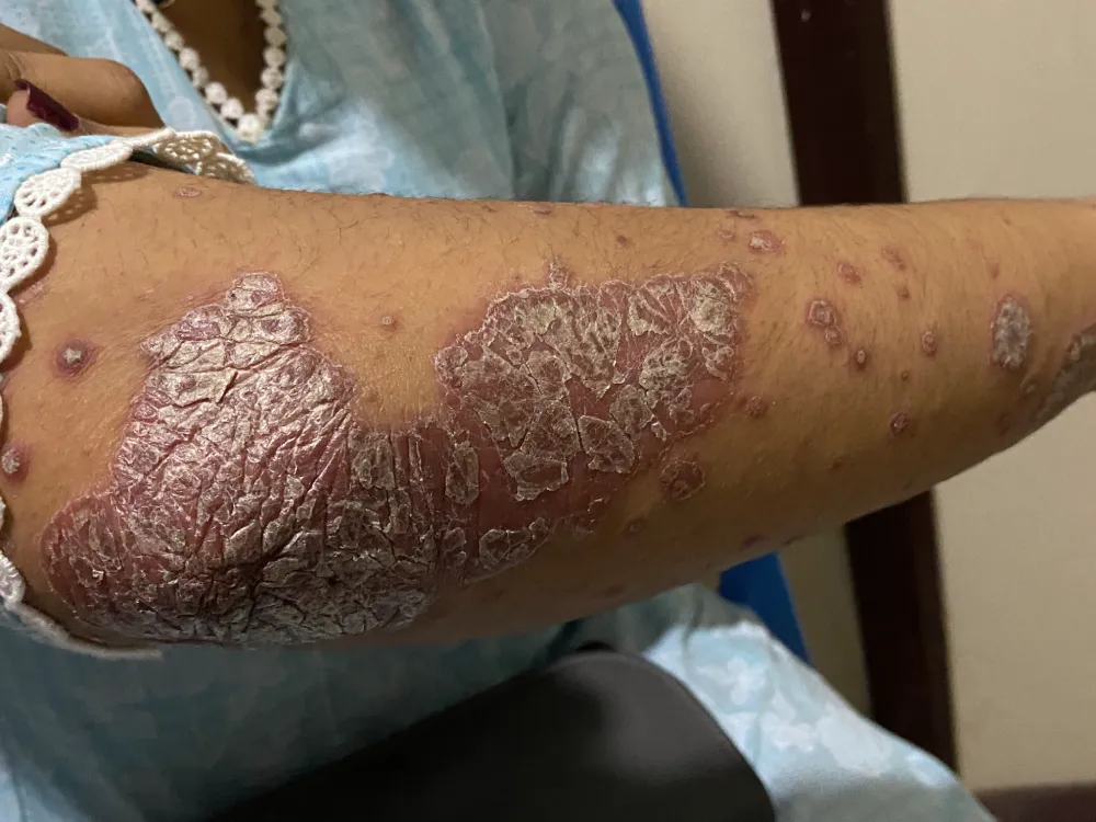 psoriasis 1