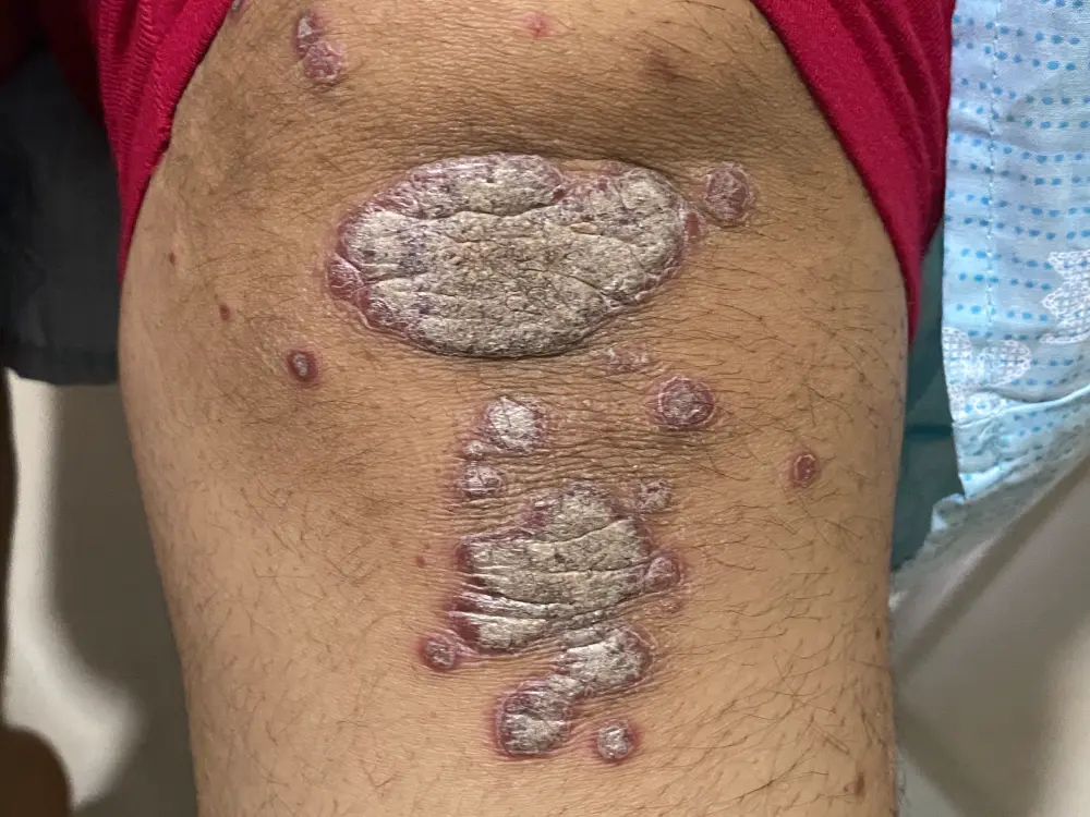 psoriasis