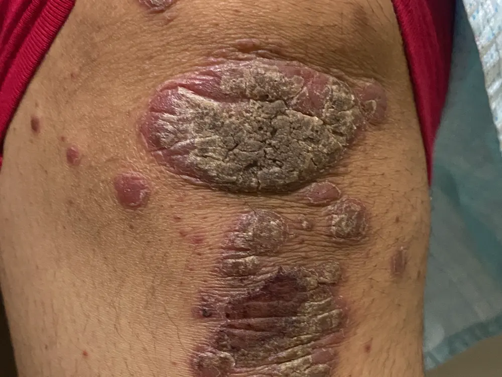 psoriasis 4