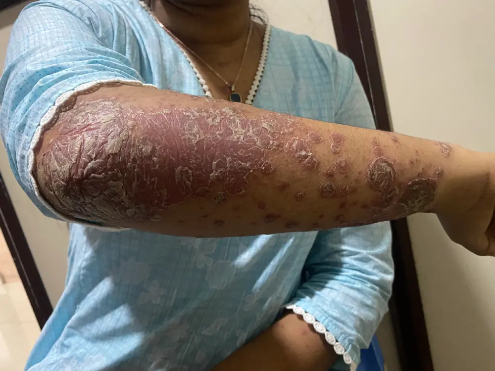 psoriasis5